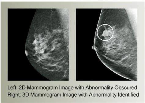 the villages diagnostic mammogram